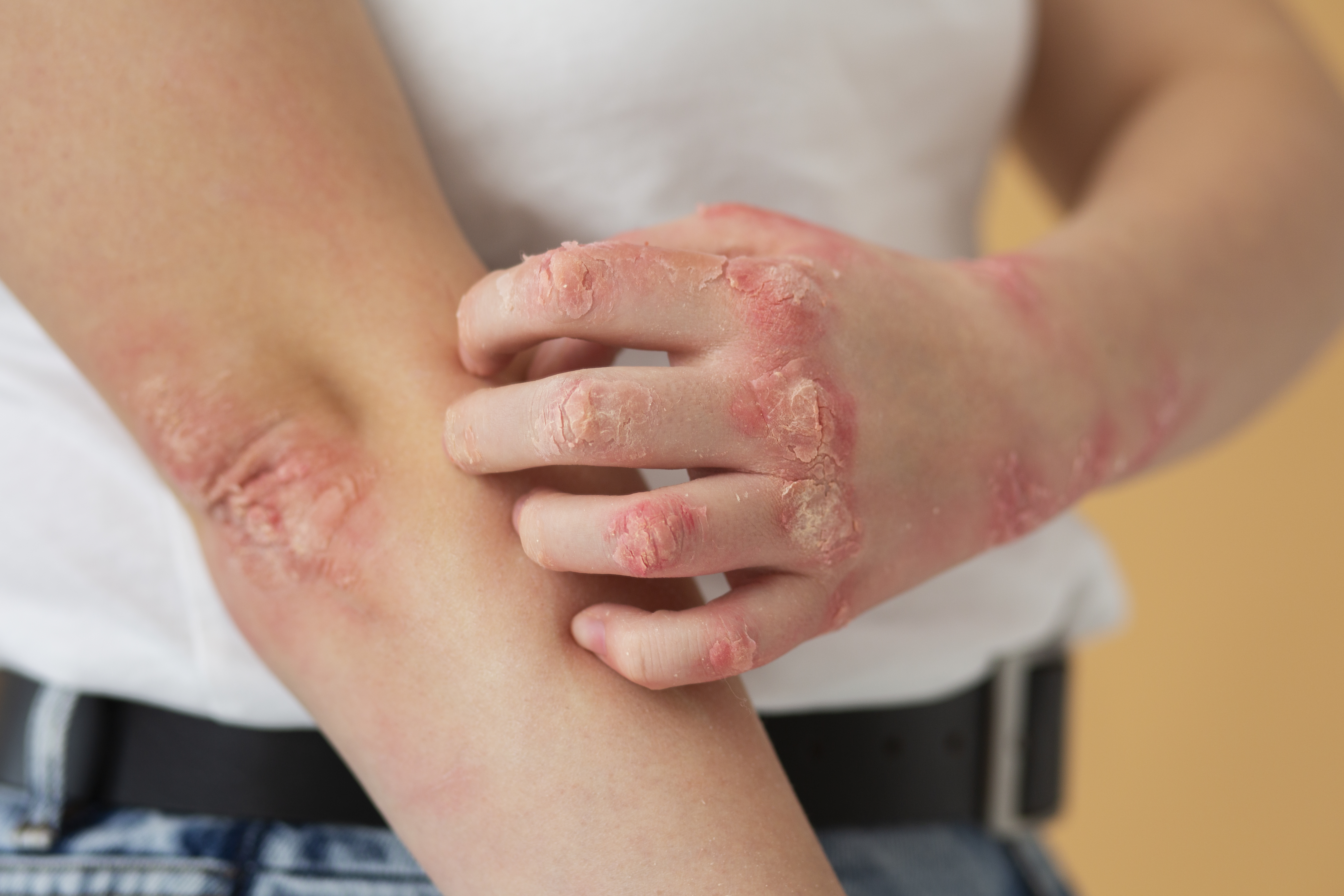 Psoriasis ayurvedic treatment